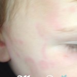 Les allergies de bébé : les déceler, les comprendre et réduire les risques